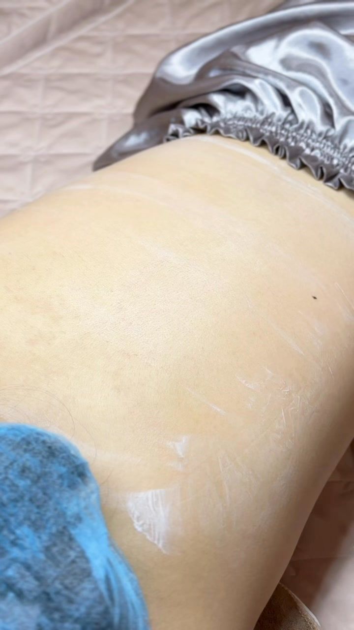 Khách nằm chăm sóc da mụn lưng và thâm lưng tại spa