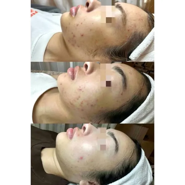Ảnh trước và sau của khách tại tiệm, mắt đã được che