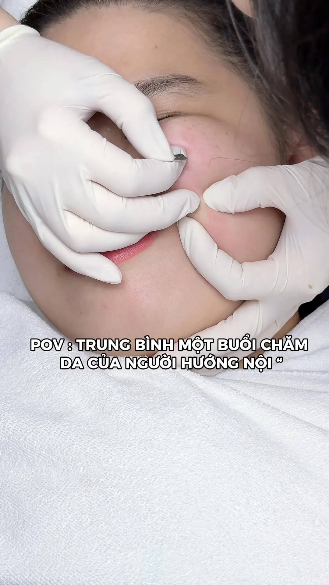 Kỹ thuật viên nặn mụn bằng tay nhẹ nhàng trên da khách tại tiệm spa Phú Nhuận