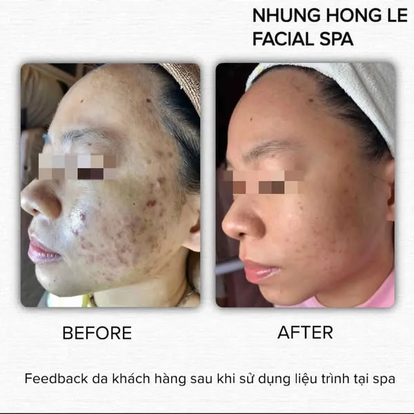 Hình ảnh trước và sau buổi nặn mụn bằng tay tại tiệm spa Phú Nhuận