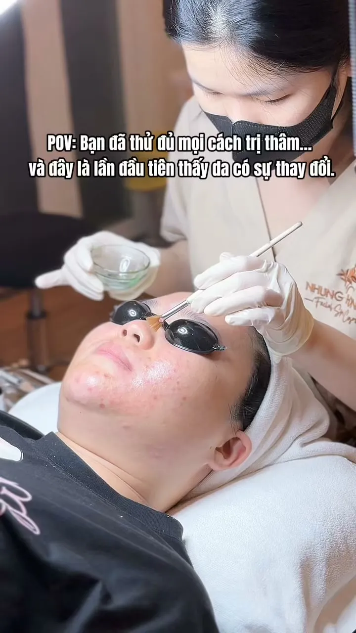 Kỹ thuật viên thực hiện thao tác quét dung dịch peel lên da mặt khách hàng đeo kính bảo hộ