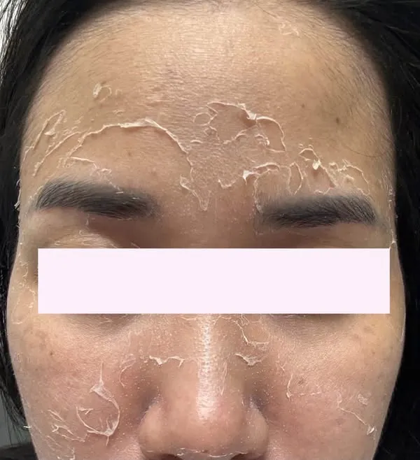 Làn da bong tróc tự nhiên từng mảng sau Yellow Peel, vùng mắt được che chắn cẩn thận