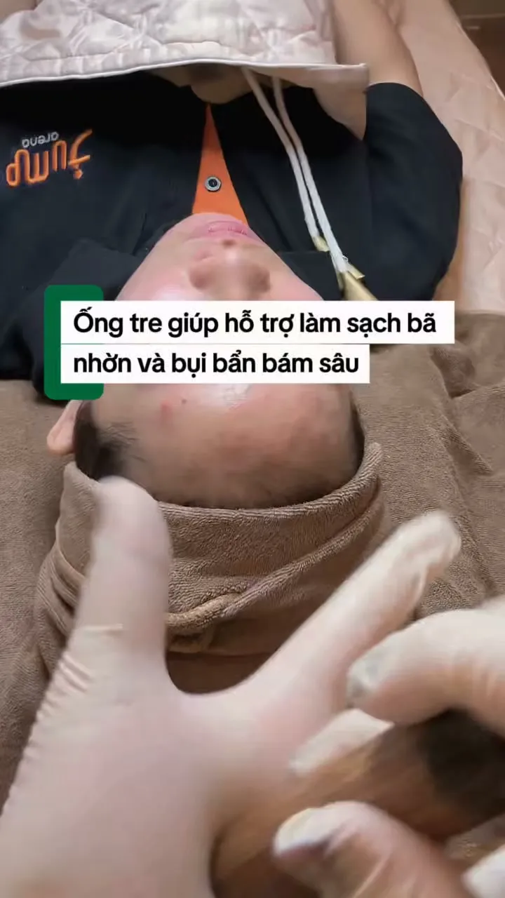 Kỹ thuật viên hút máu thâm bằng ống tre sau khi nặn mụn