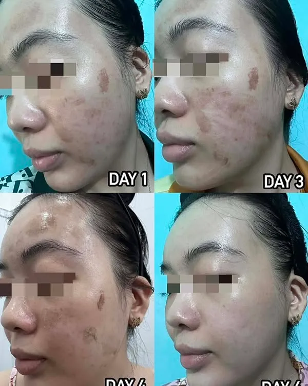 Theo dõi bề mặt da sau liệu trình peel
